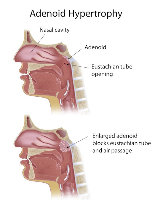 Adenoid Hypertrophy Causes Homeopathic Treatment