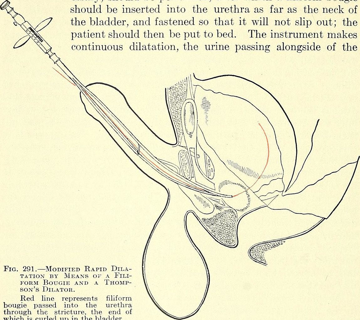 The second urethral stimulation sounding images