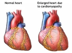 Cardiomyopathy, Alcoholic; Alcoholic Cardiomyopathy