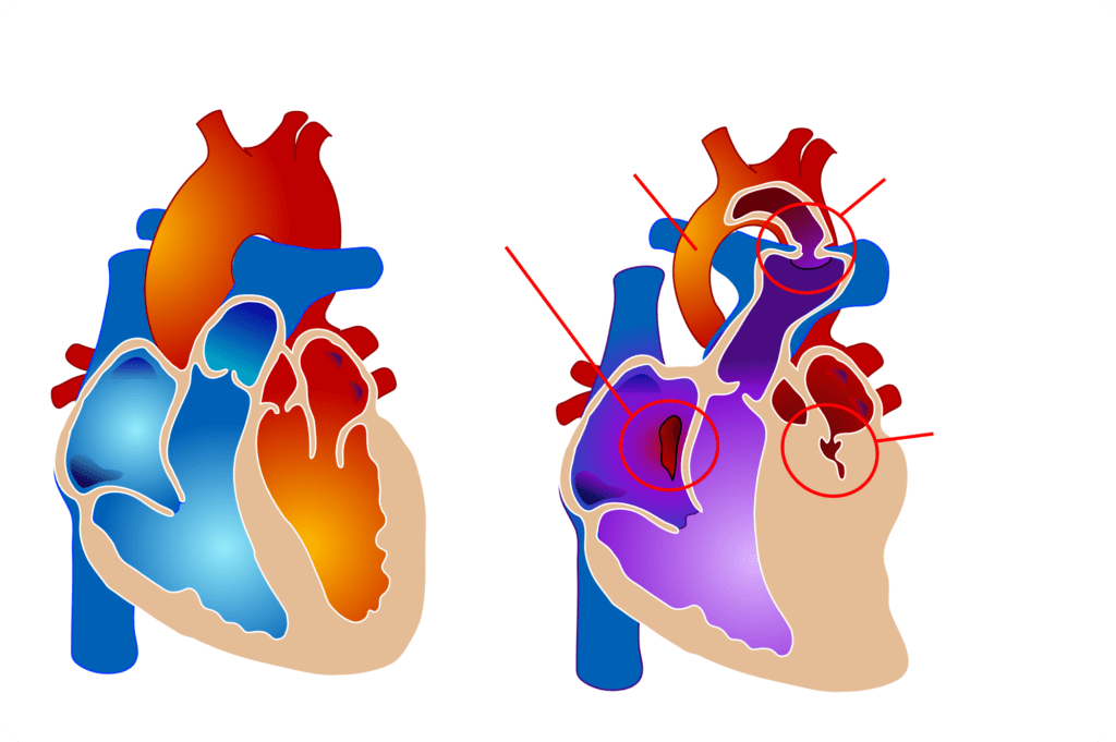 2000px-Hypoplastic_left_heart_syndrome_-no_text-.svg | Dr. Thind