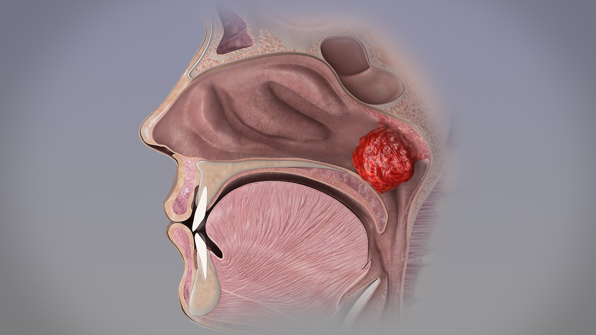 Adenoid Hypertrophy Causes Homeopathic Treatment