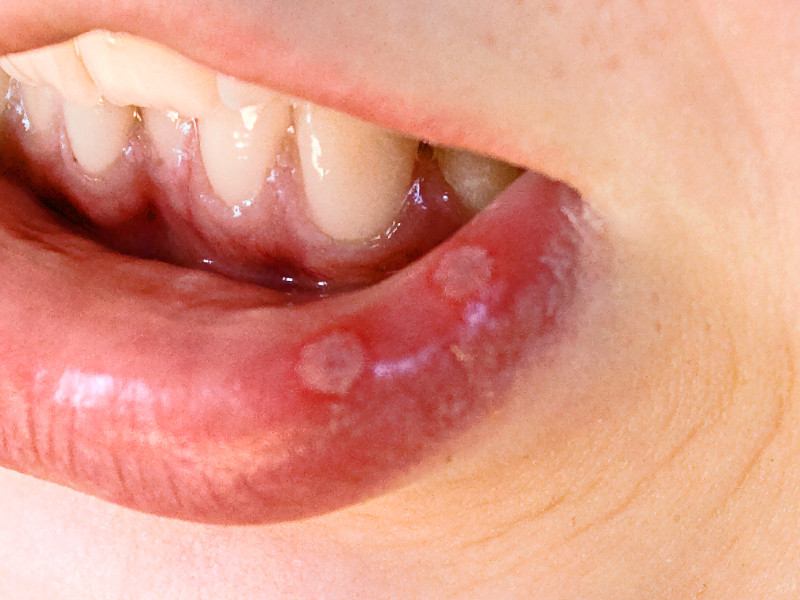 aphthous-ulcers-mouth-sores-causes-treatment-dr-thind