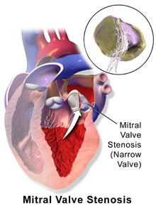 Mitral Stenosis | Heart Disease, Shortness of Breath, Tiredness | Dr. Thind