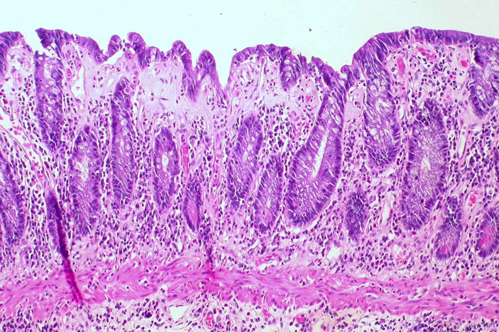 collagenous-colitis-causes-symptoms-treatment-dr-thind