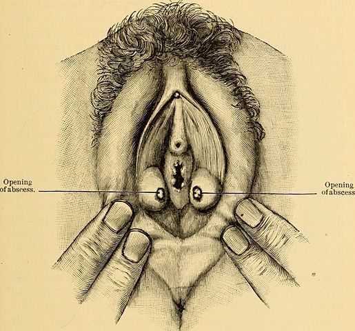 Bartholin's cyst // Middlesex Health