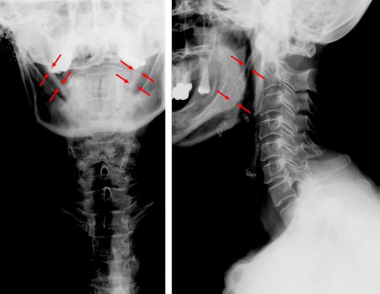 Eagle S Syndrome Dr Thind