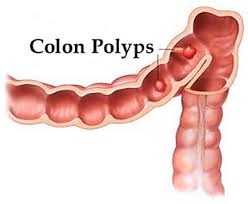 Colon Polyp Causes,Symptoms,Diet &Treatment | Homeopathy