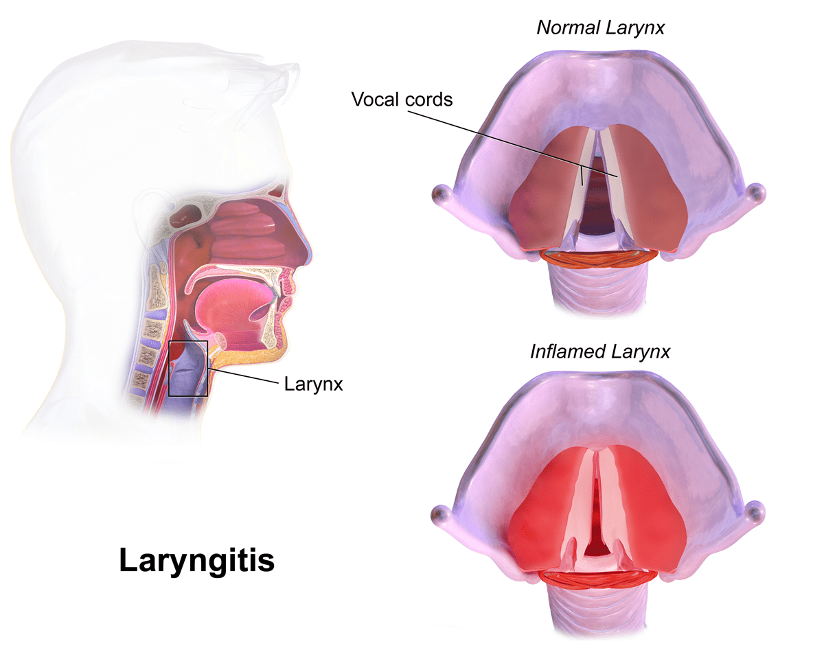 Laryngitis Causes Sign Symptoms Homeopathic Treatment