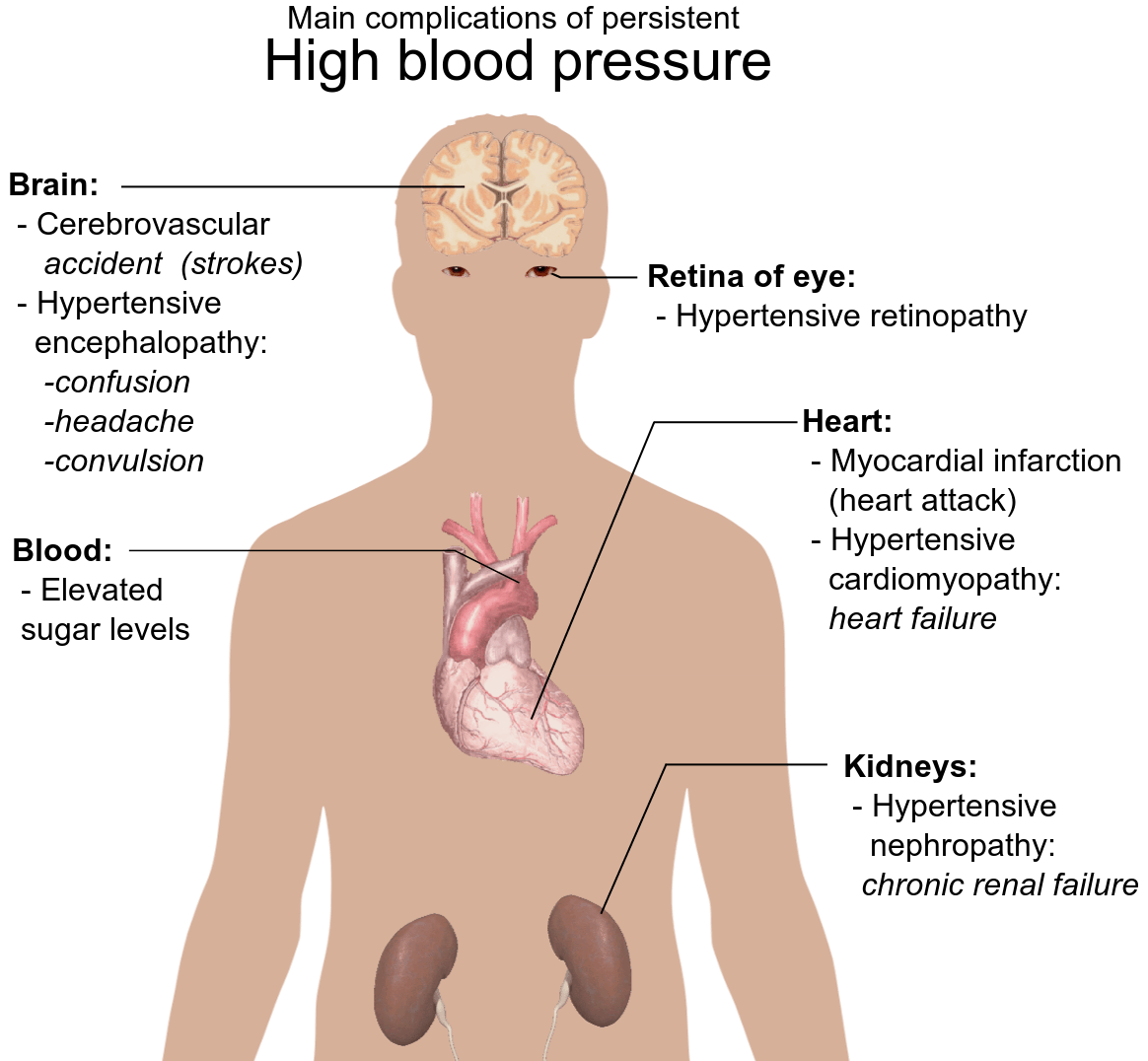 High Blood Pressure Hypertension Stage 2 Treatment