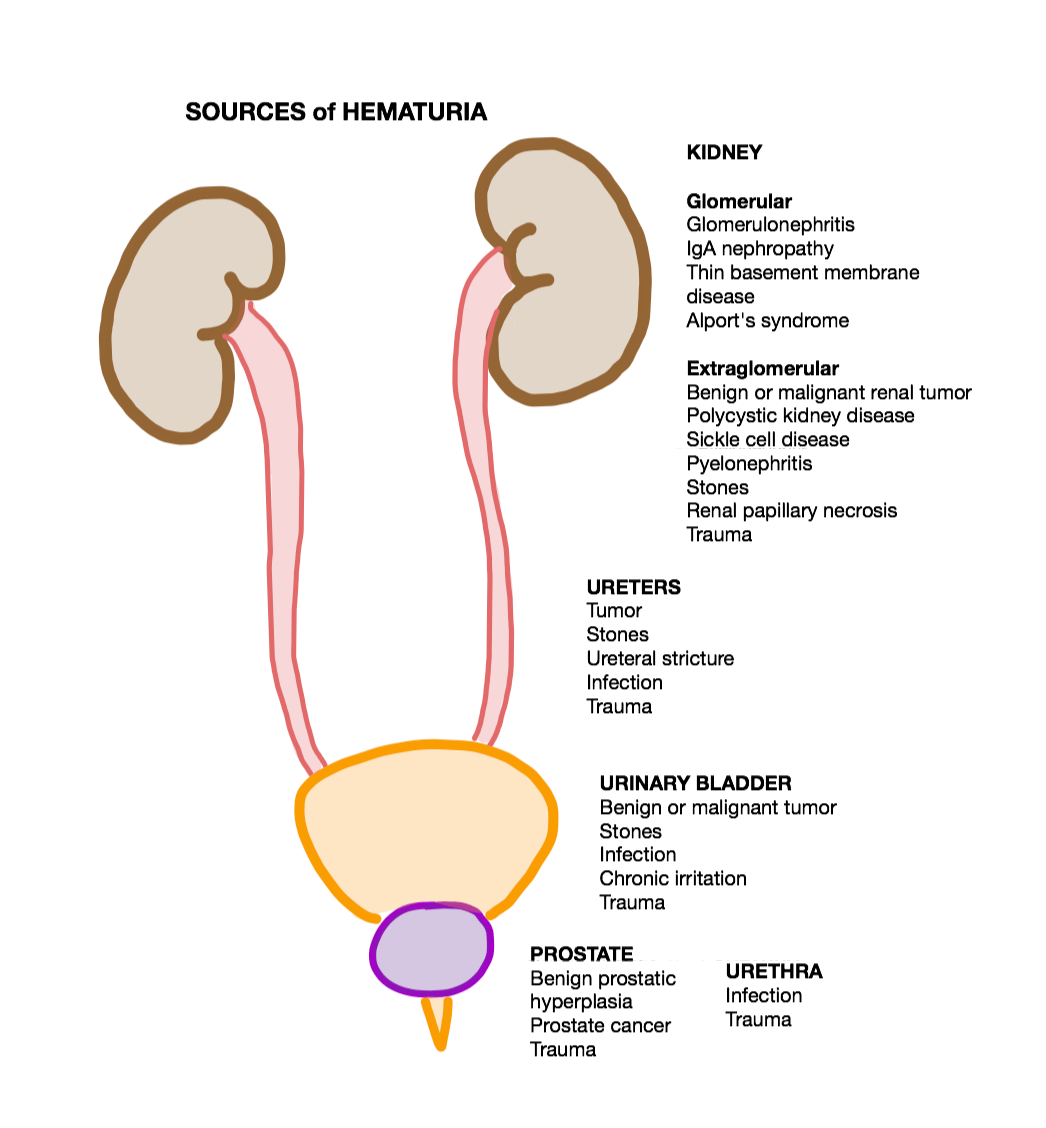 hematuria-causes-symptoms-homeopathic-treatment