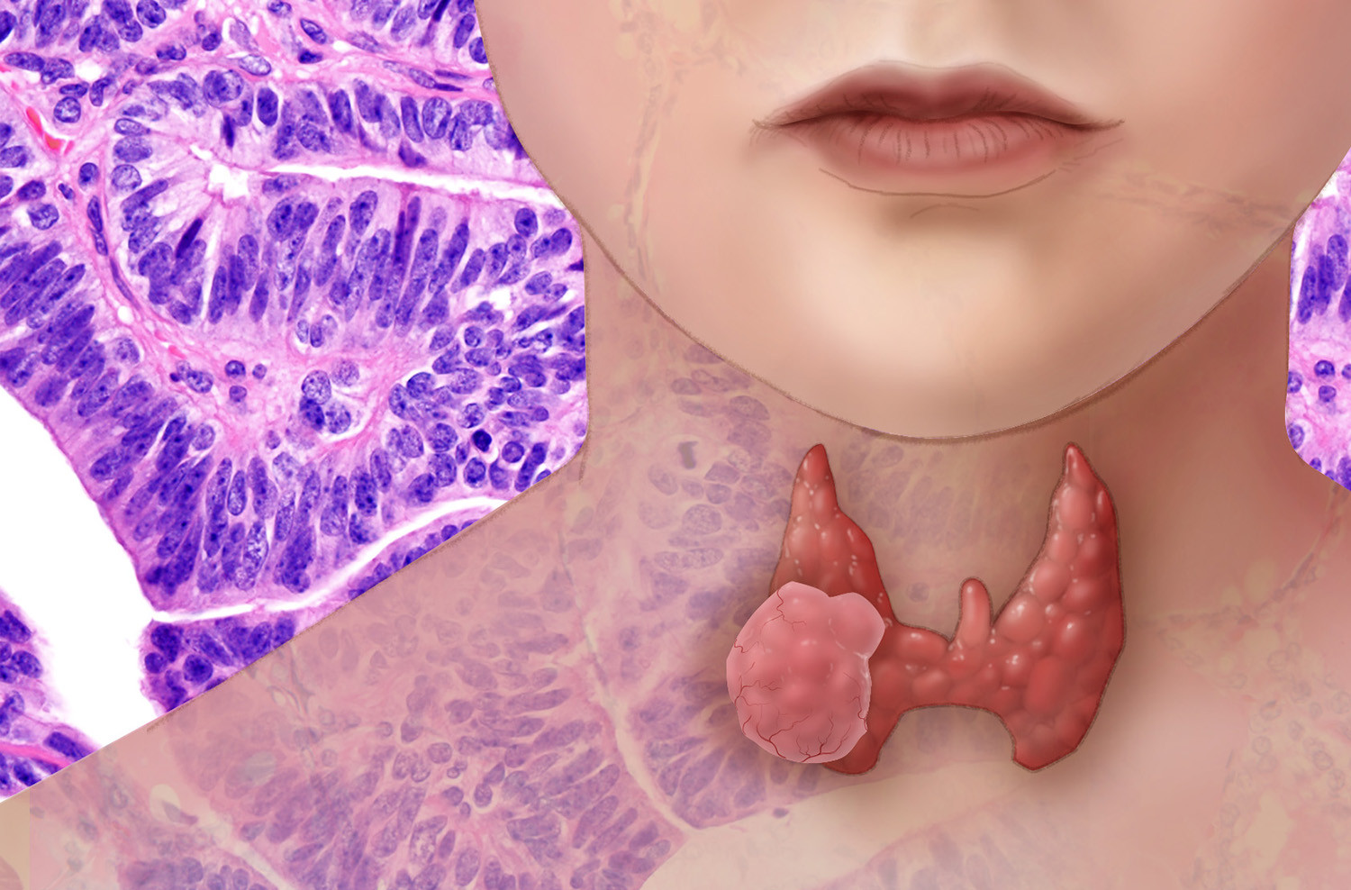 anaplastic-thyroid-carcinoma-pathophysiology-treatment