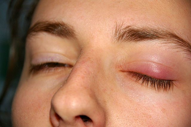 chalazion-causes-symptoms-homeopathic-treatment