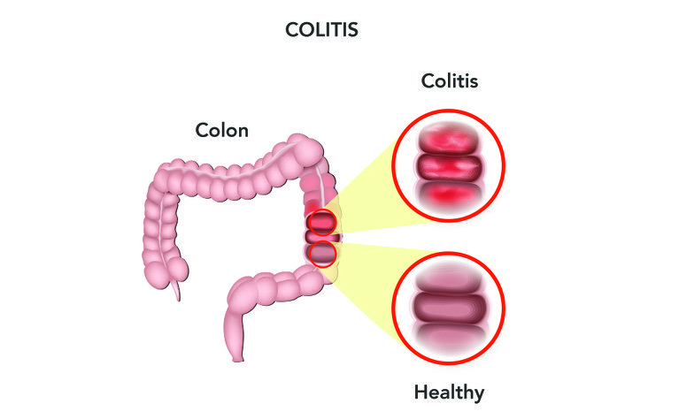 collagenous-colitis-causes-symptoms-treatment-dr-thind