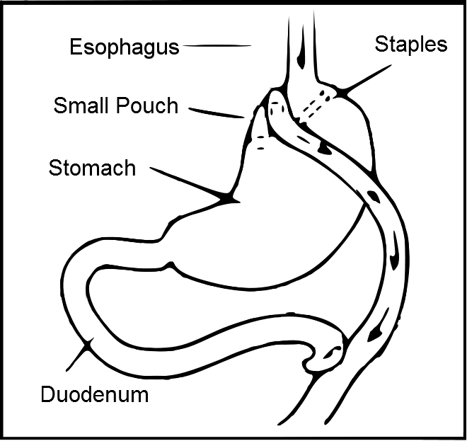 Dumping Syndrome Rapid Gas Emptying Dr Thind Homeopathy