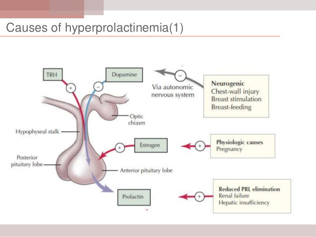 hyperprolactinemia-causes-symptoms-homeopathic-treatment