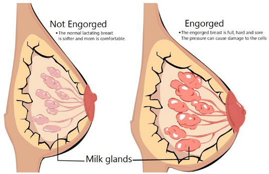 Engorged breasts: Symptoms, causes, and treatment
