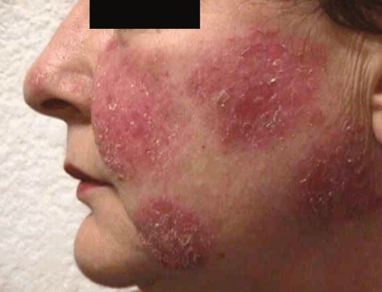 Pemphigus Vulgaris Treatment | Dr. Thind's Homeopathy