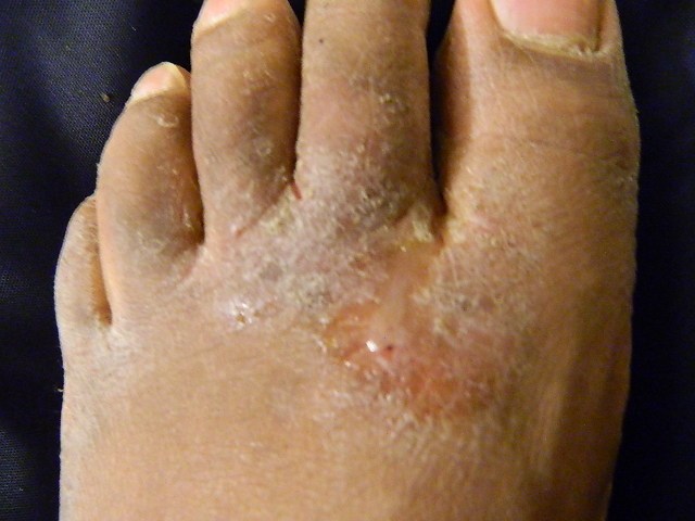 Athletes Foot Causes Signs And Symptoms Treatment