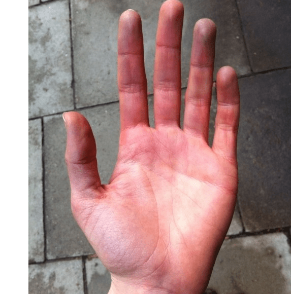 grey hands symptoms        <h3 class=