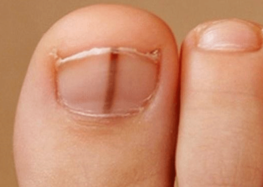 big-toenail-has-vertical-light-brown-line-melanoma-scary-symptoms