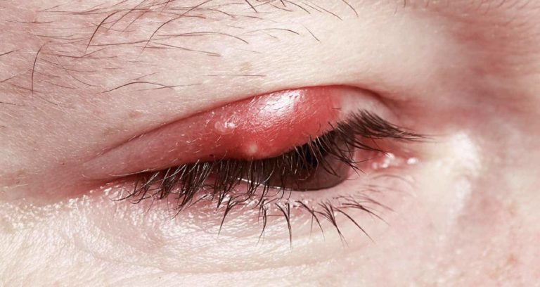 How To Manage Stye. The Dos and Don’ts | Dr. Thind