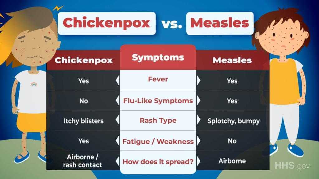 Chickenpox VS Measles (Rubeola) | Dr. Thind's Homeopathic Treatment