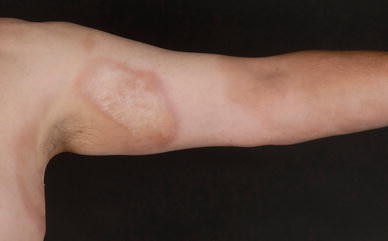 Morphea Skin Disease Treatment In Homeopathy | Dr. Thind’s Homeopathic ...